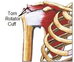 Torn Rotator Cuff Symptoms And Treatment - Shoulder Pain Explained