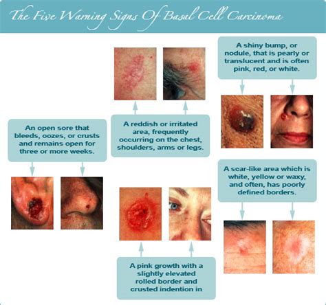 Basal Cell Cancer in Mill Valley, CA | ﻿Aesthetic Dermatology And Skin ...