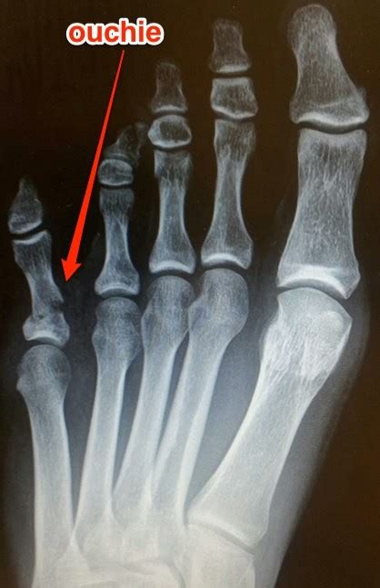 Dislocated Pinky Toe Xray