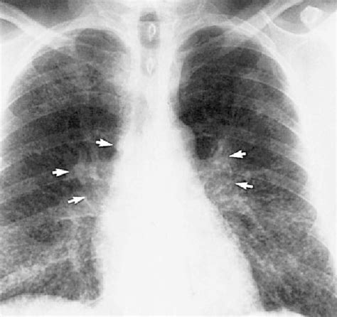 Figure 2 from Chest x-ray stages of sarcoidosis. | Semantic Scholar