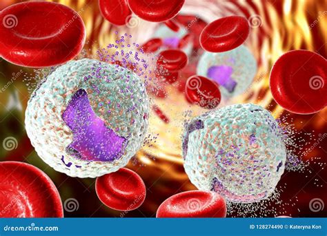 Treatment of Acute Lymphoblastic Leukemia Stock Illustration - Illustration of lymphoma, blast ...