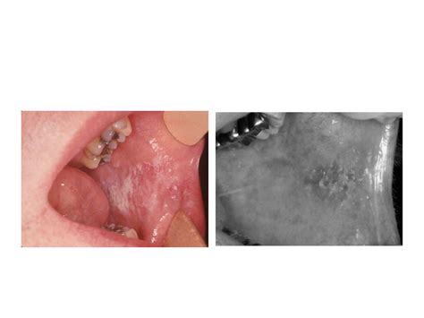 Cheek chewing Morsicatio buccarum, chronic chewing of cheek, - ppt video online download