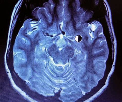 Hypothalamic Hamartoma-MRI - Sumer's Radiology Blog