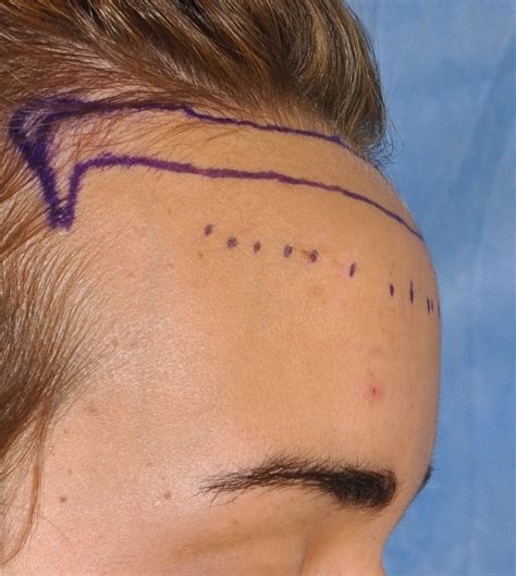 Frontal hairline advancement with frontal bossing redeuction before side view Dr Barry Eppley ...