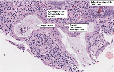 Colon – Ulcerative Colitis – NUS Pathweb :: NUS Pathweb