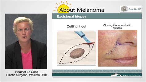 How is melanoma removed? - YouTube