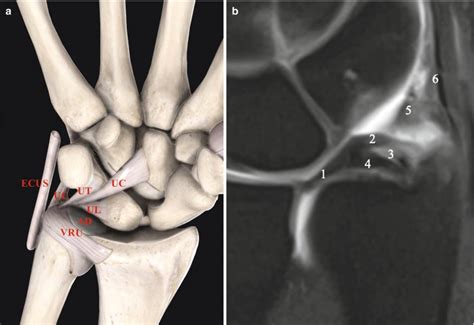 Ulnar Collateral Ligament Wrist Mri