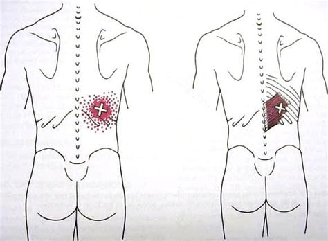 Serratus Pos Inf Trigger Point Diagram | Trigger points, Love massage ...