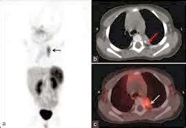 Medical Treatment Pictures-for Better Understanding: Opsoclonus-Myoclonus Syndrome