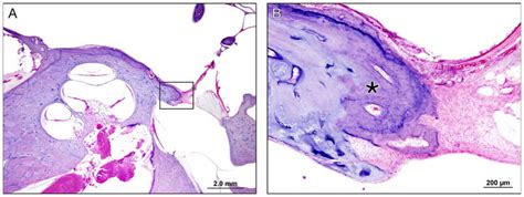 Otosclerosis Histology