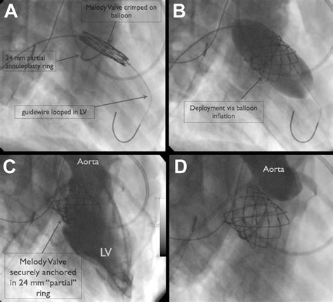 Figure 1 from Melody valve-in-ring procedure for mitral valve ...