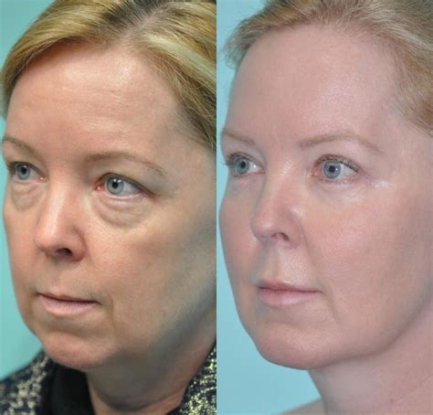 Blepharoplasty photos | Chevy Chase, MD | Patient 11850