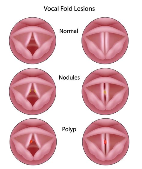 Laryngoscopy of the Voice Box (Laryngoscopy) - Fort Worth ENT