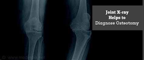 Osteotomy - Types, Risks & Complications