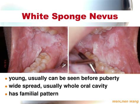 PPT - 1. White lesions of the oral mucosa 2. Solitary oral ulcer and fissures PowerPoint ...