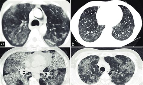 (a-d) COVID-19 mimics. Patchy consolidation with a predominantly... | Download Scientific Diagram