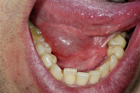 Swollen Sublingual Salivary Gland Photograph by Dr P. Marazzi/science ...