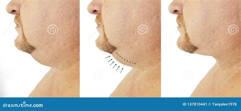 Submental Fat Man before and after, Procedures Treatment Stock Image ...