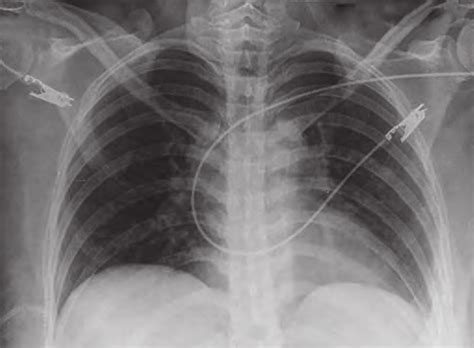 Chest radiography of admission, where RFs of the lower left costal ...