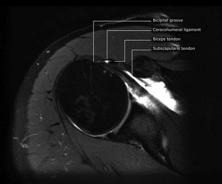 Long Head Of Biceps Tendon Dislocation Radiology Reference Article | My XXX Hot Girl