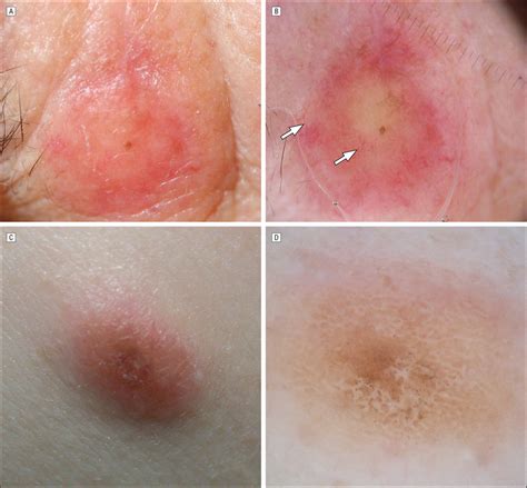 Pure and mixed desmoplastic melanomas (DMs) may be indistinguishable... | Download Scientific ...