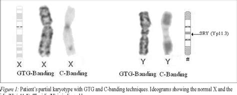 Figure 1 from Mixed gonadal dysgenesis with 45,X/46,X,idic(Y)/46,XY,idic(Y) karyotype ...