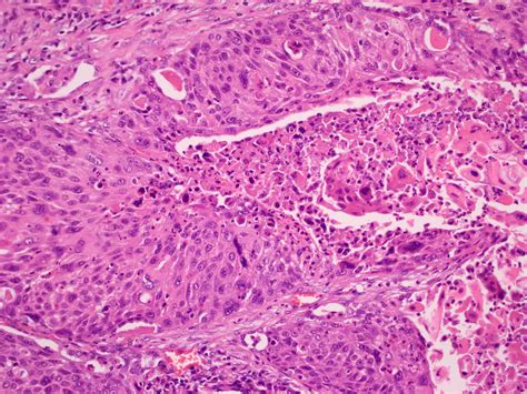 Squamous Cell Carcinoma Lung Histology