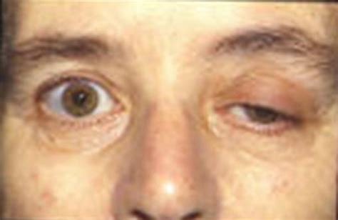 Myasthenia Gravis - Causes, Symptoms, Diagnoses, Treatment, Pictures ...