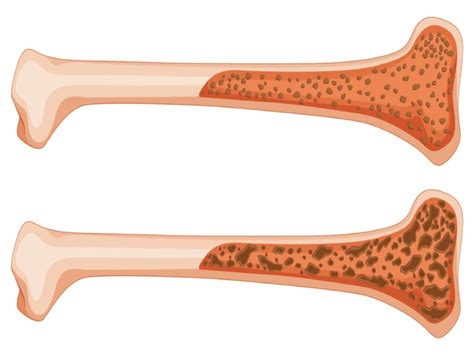 Osteomalacia Causes and Treatment | Dr. Praharsha