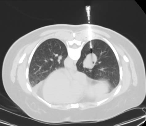 CT guided biopsy of the right infrahilar mass. | Open-i