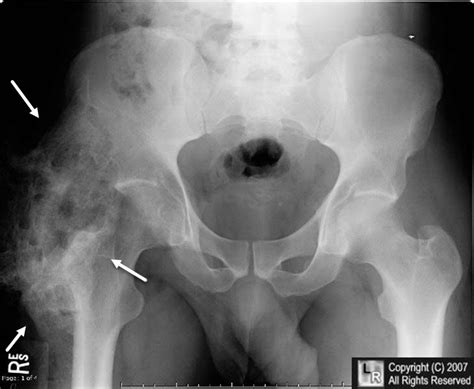 LearningRadiology - Heterotopic, Ossification, HO