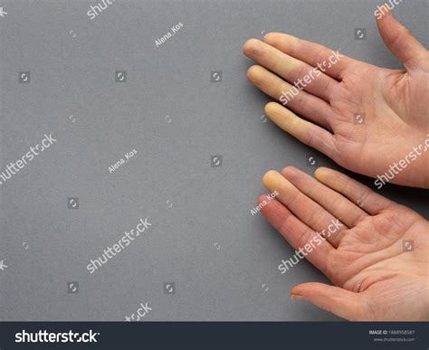 Raynauds Disease Syndrome Hands Young Woman Stock Photo 1888958587 | Shutterstock