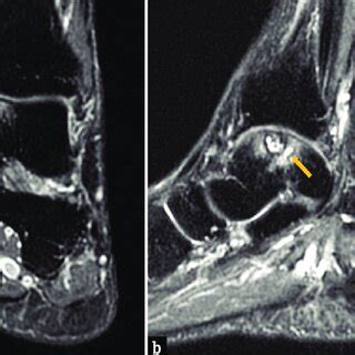 CT examination revealed a large cyst lesion over medial talar dome ...