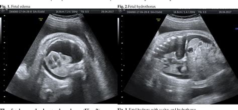 Alloimmunization And Non-immune Hydrops Fetalis (Chapter, 56% OFF