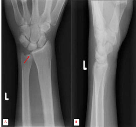 Cureus | Repetitive Microtrauma and Negative Ulnar Variance as Possible ...