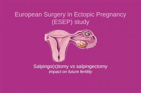 (PPT) Salpingo(s)tomy vs salpingectomy impact on future fertility ...