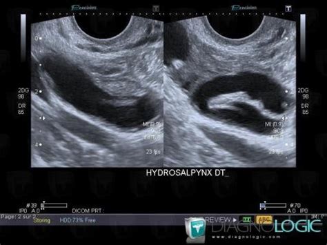 Radiology case : Hydrosalpinx (US) - Diagnologic