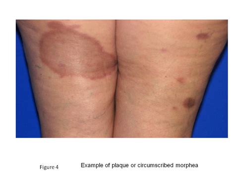 Morphea (Localized Scleroderma) - The Clinical Advisor