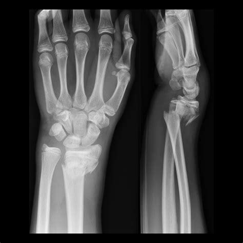 Teenager with wrist pain after falling on an outstretched hand ...