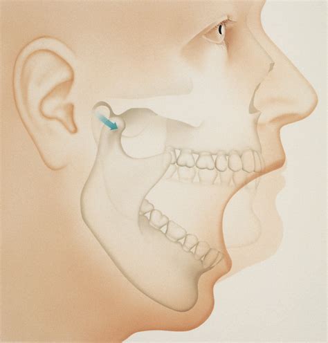 Temporomandibular Disorder/TMJ (Jaw Joint Disorders) - Seattle Smiles Dental