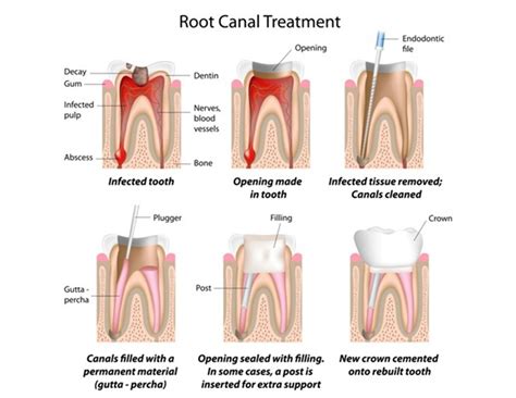 Root-canal-treatment-infographics | Kayawell