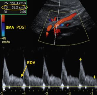 Inferior Mesenteric Artery Ultrasound