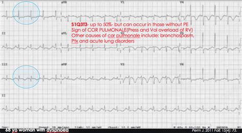 The ECG's of Pulmonary Embolism - Resus