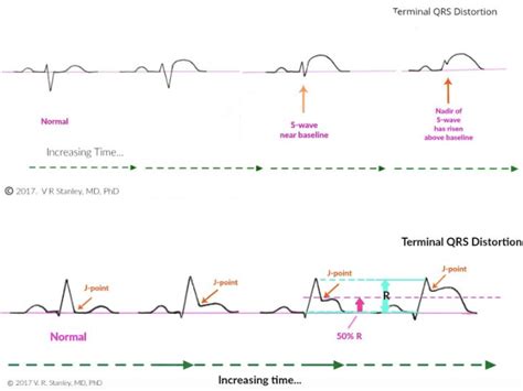 Benign Early Repolarization vs. Anterior STEMI - County EM