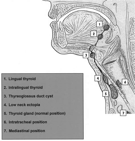 Ectopic submandibular thyroid tissue with a coexisting active and normally located thyroid gland ...