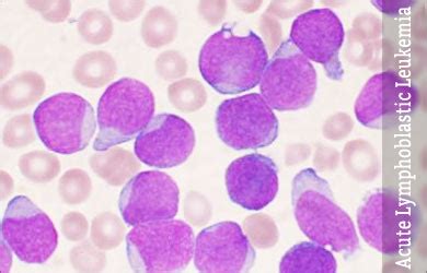 Acute Lymphoblastic Leukemia - Incidence Causes Symptoms Diagnosis ...