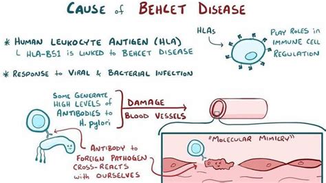 Causes of behcet syndrome - MEDizzy