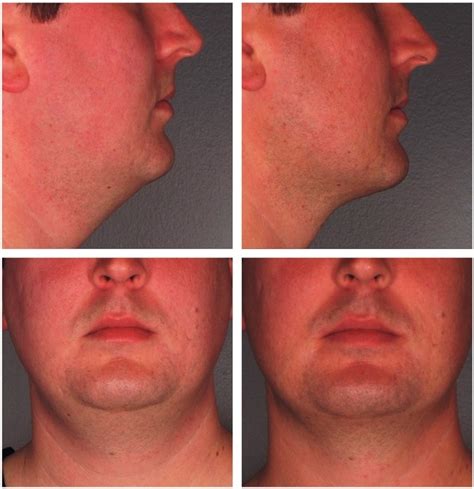 Chin Reduction | Kybella | Before & After | Beverly Hills | WeHo | CA