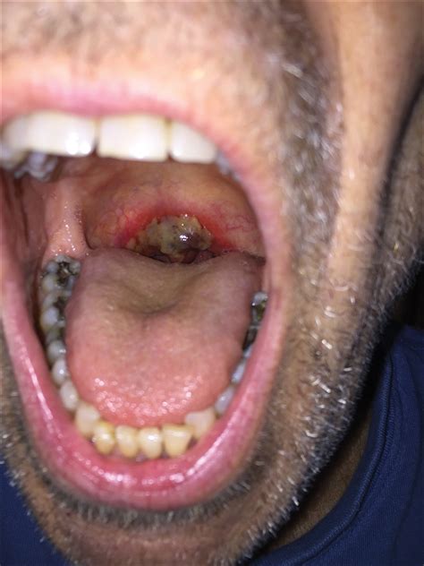 Friable Erythema and Erosions on the Mouth | MDedge Dermatology