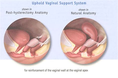 Mesh Grafting for Pelvic Floor Reconstruction | Obstetrics and Gynecology Associates of Hampton